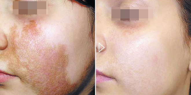 Ārstēšana no гиперпигментации - фото до и после