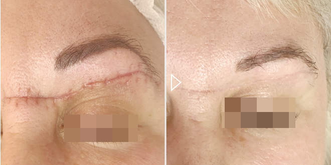 Удаление rubцов и шрамов - foto до и после