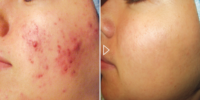 Uzdalījums угрей и прыщей - фото до и после