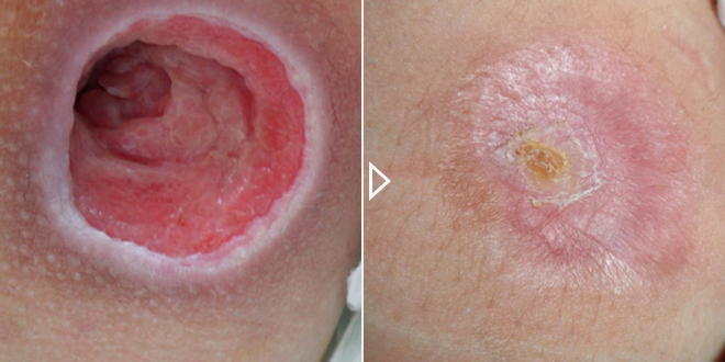 Akūtu un hronisku brūču dzīšanas paātrināšana